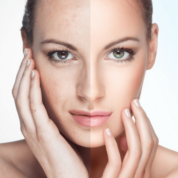 VI-Peel-Glam+Glo-Medical-Aesthetics-Lounge